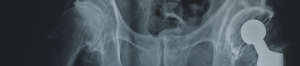 DePuy Defective Hip Device