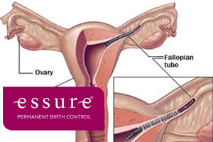 does caresource cover essure